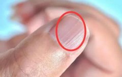指甲上有豎紋是怎么回事？指甲上有黑線